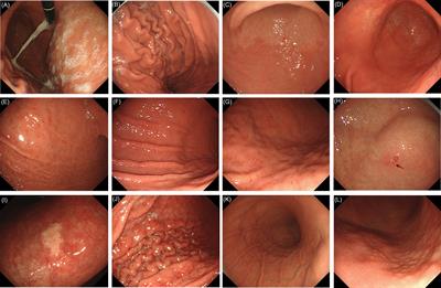 Accuracy of Endoscopic Diagnosis of Helicobacter pylori Based on the Kyoto Classification of Gastritis: A Multicenter Study